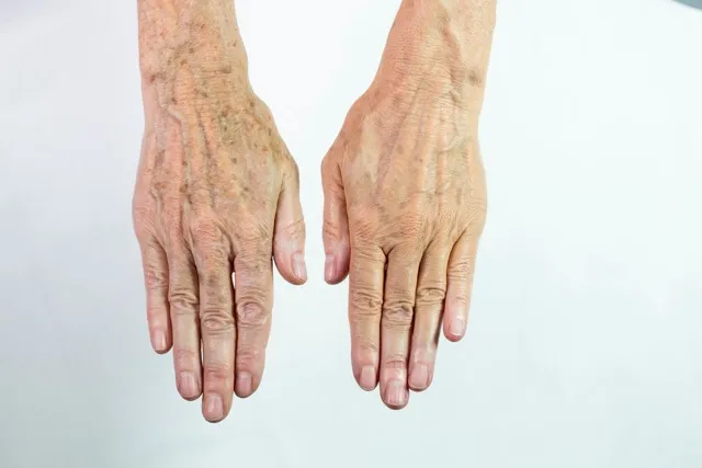 Aging Hands Rejuvenation