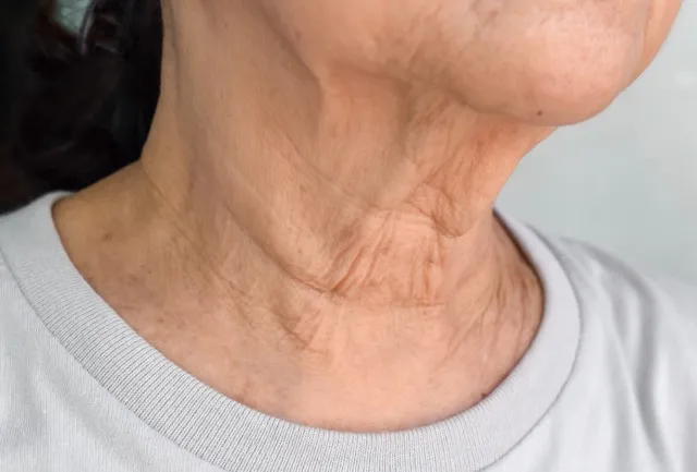 Aged Neck Tightening