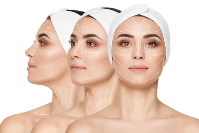 Facial contouring using thread lifting treatments