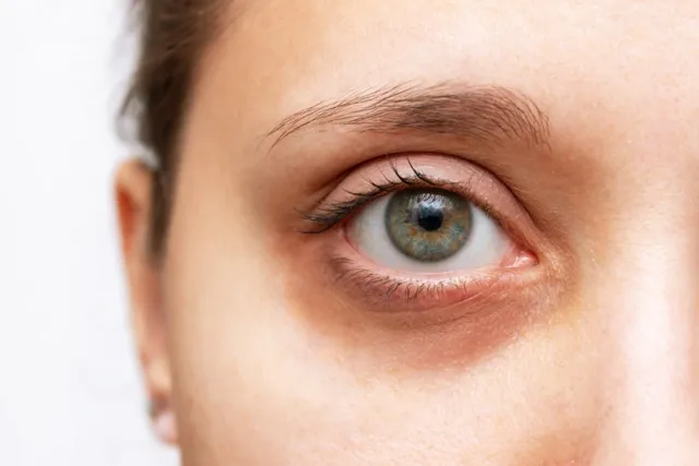 Dark circles and eye bags are common cosmetic concerns caused by various factors, including genetics, lifestyle, and aging.