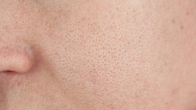 Enlarged Pores Treatment and Reduction