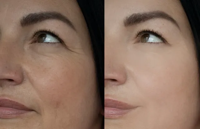 Fine Lines & Wrinkles Treatment