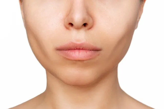 Flattened cheeks can result from aging, weight loss, or genetics, leading to a lack of volume and midface definition.