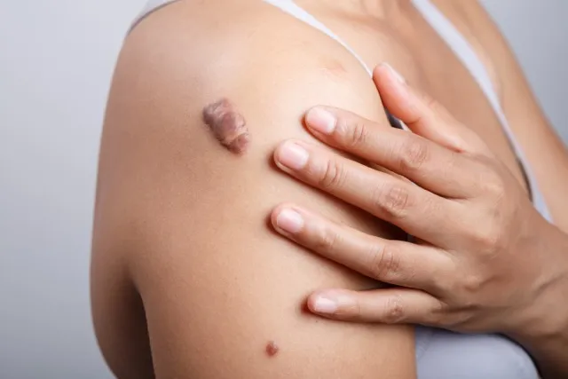 Advanced treatments for reducing the appearance of keloid scars from injuries, surgeries, and acne.