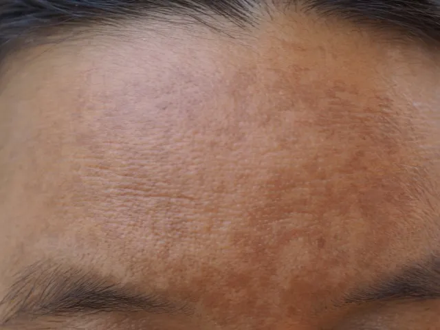 Comprehensive treatments for reducing melasma and achieving an even skin tone.