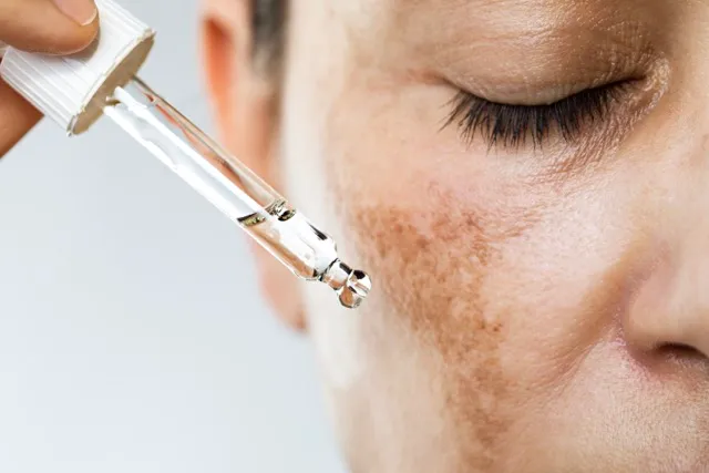 Achieve a clear, radiant complexion with our advanced hyperpigmentation treatments.