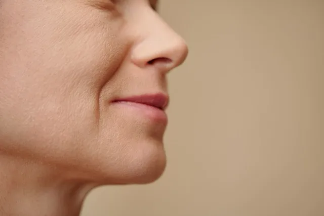 Nasolabial folds and marionette lines are common signs of aging that can make you look older than you feel.