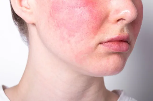 Achieve clearer, calmer skin with our advanced treatments designed to target rosacea redness and inflammation.