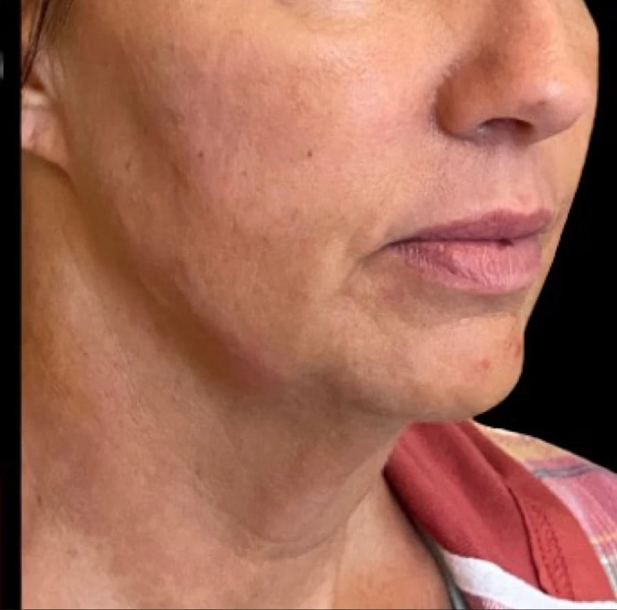 Dermal Fillers after