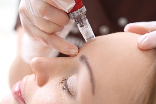 Microneedling treatment for enhancing skin texture and tone
